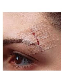 Pansement de suture adhésif hypoallergénique 3M.jpg